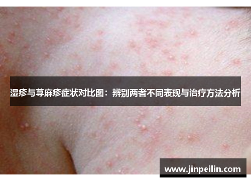 湿疹与荨麻疹症状对比图：辨别两者不同表现与治疗方法分析